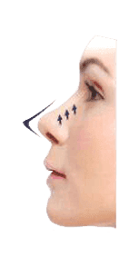 Ultra face V lift