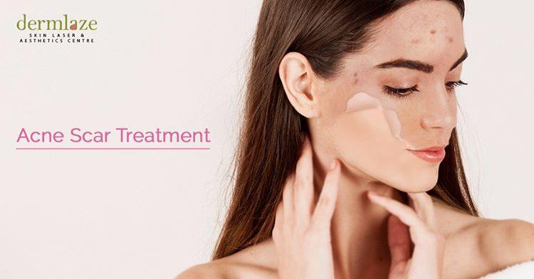 acne treatment effectiveness after microdermabrasion in Malaysia