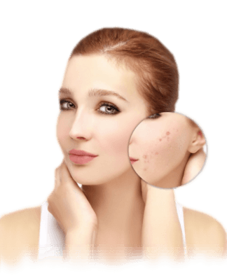 Acne Treatment in Malaysia - Get Rid of Acne And Scars ...